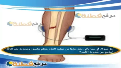 أي مما يأتي يعد جزءًا من عملية التئام عظم مكسور ويحدث بعد ثلاثة أسابيع من حدوث الكسر